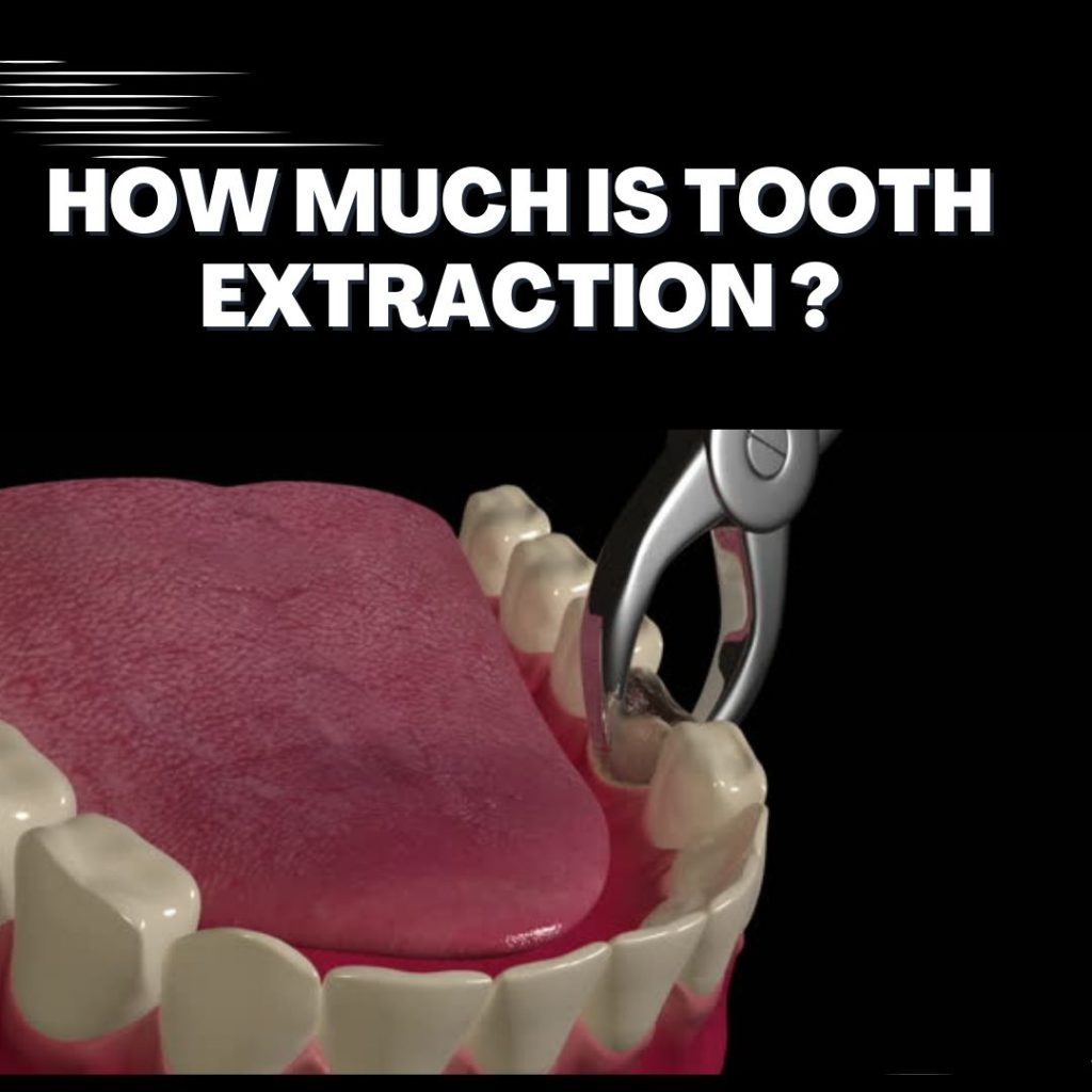 How much is tooth extraction