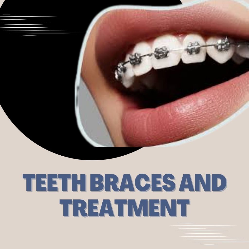 Teeth Braces and Treatment