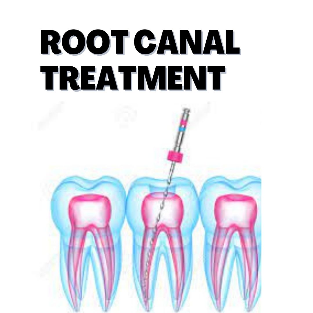 Root Canal Treatment Cost in Uganda TM Dental Solution