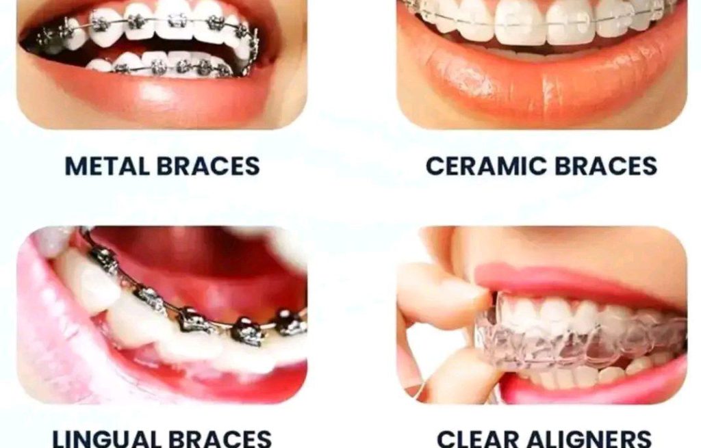 types of Dental Braces