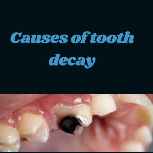 4 Causes of Tooth Decay in Uganda