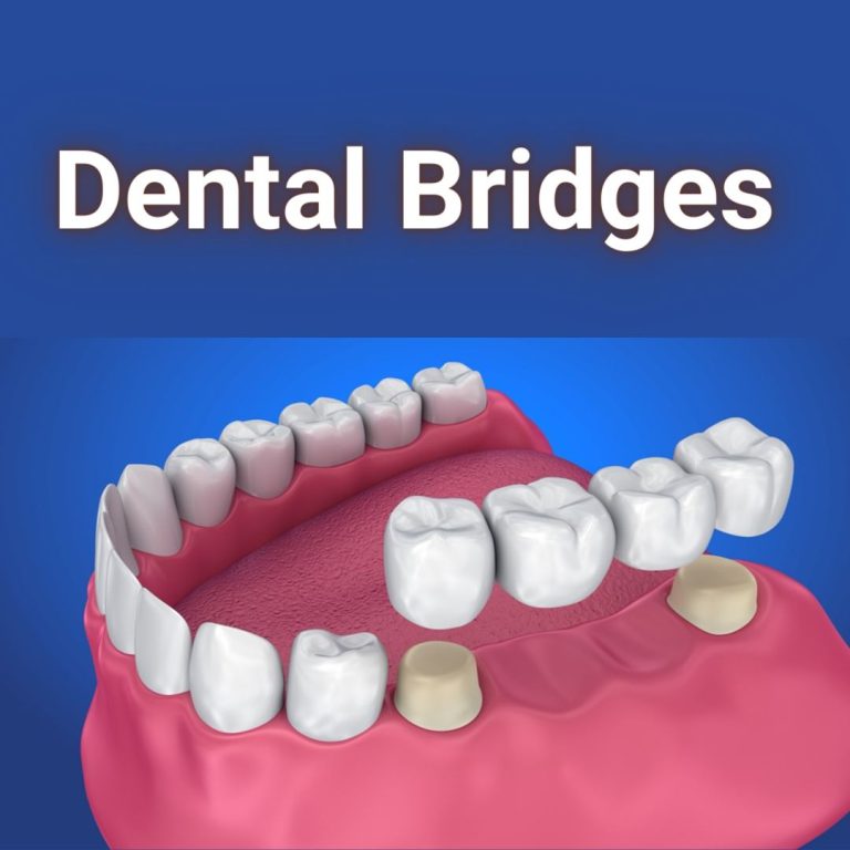 Dental Bridges: Types & Who Needs Them