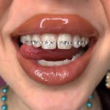 Are Tooth Gems Safe for Your Smile?