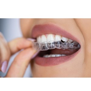 Dental Aligners