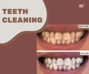 How Much is Teeth Cleaning in Uganda