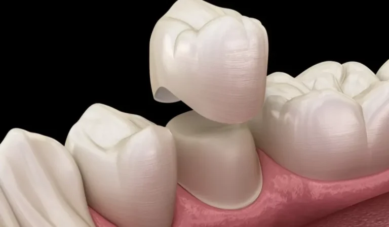 What’s The Best Dental Crowns For Your Tooth?