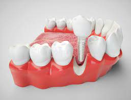 Permanent Tooth Replacement With Dental Implants  In Uganda