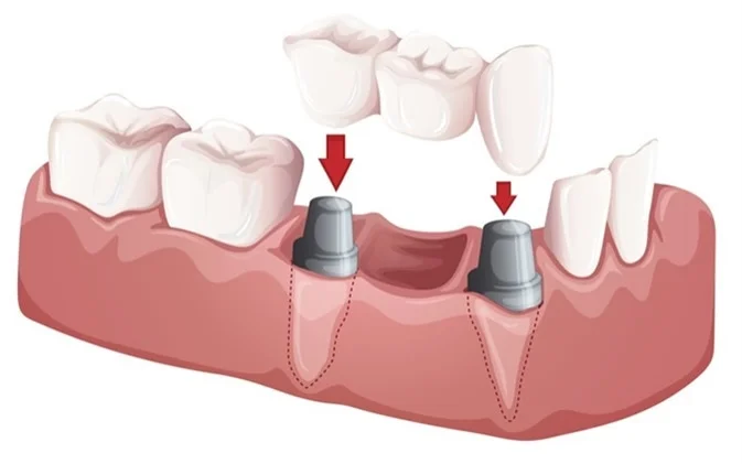 Advantages and Disadvantages of Dental Bridges