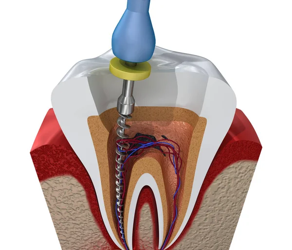 How Long Does It Take To Recover From A Root Canal?