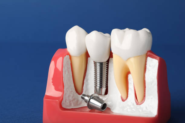 Why Replace Missing Teeth?