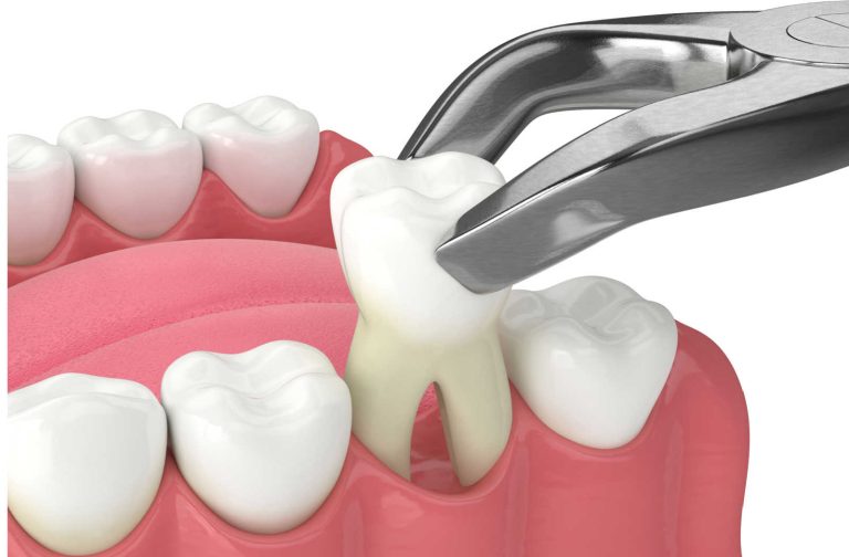 Do’s and Don’ts After Tooth Extraction | TM Dental Solutions Uganda